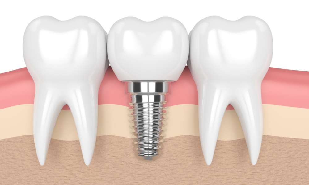 Causes and Consequences of Dental Implant Failure