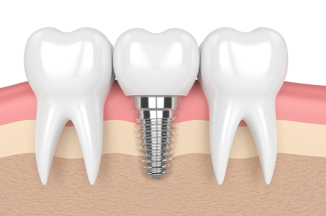 Dental Implant Turkey